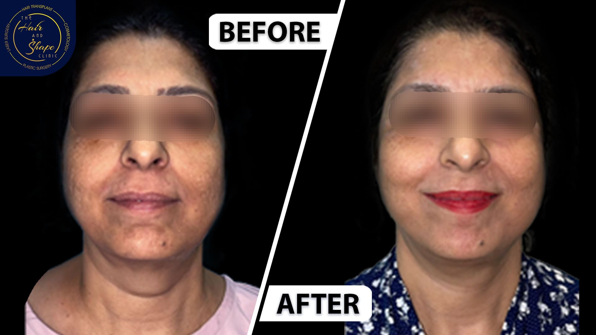 Face & Neck Lift result4